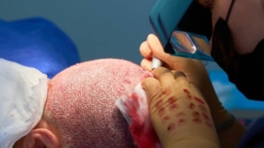How Hair Transplant Technology Delivers Better Outcomes?