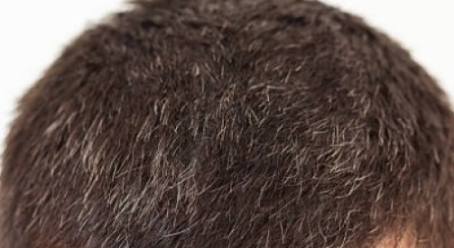 How Hair Transplants Deliver Permanent, Natural Results?