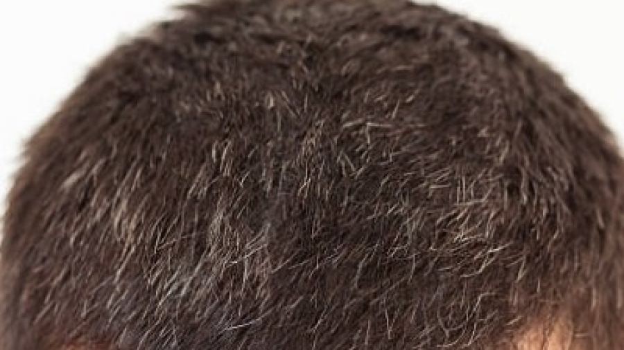How Hair Transplants Deliver Permanent, Natural Results?