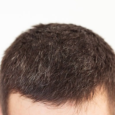 How Hair Transplants Deliver Permanent, Natural Results?