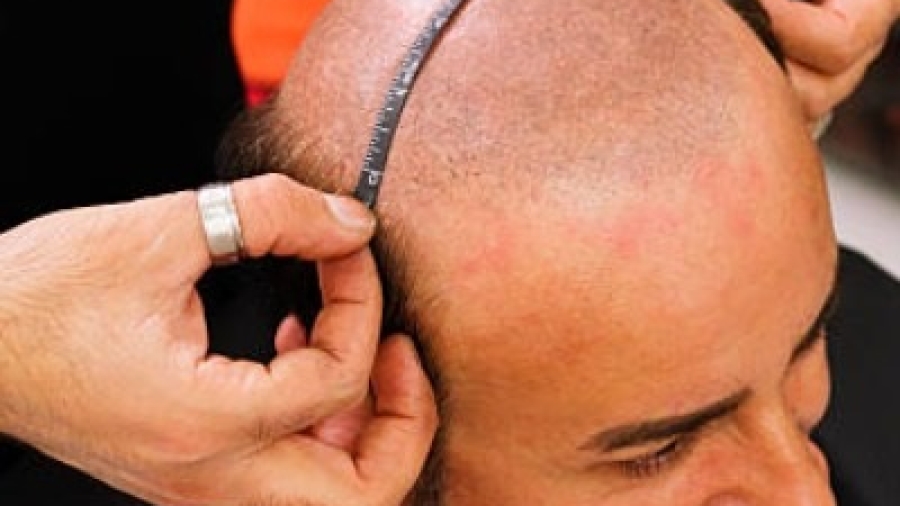 How Surgeons Ensure Natural Density After Transplant