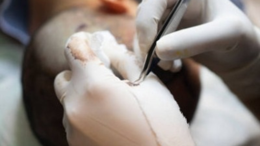 Is Hair Transplant Better Than Other Hair Treatments?