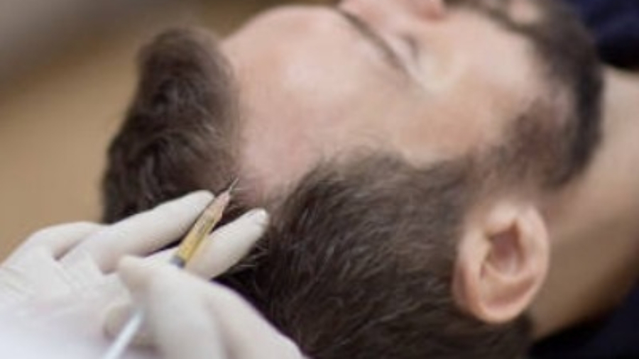 Is Hair Transplant Better Than PRP?