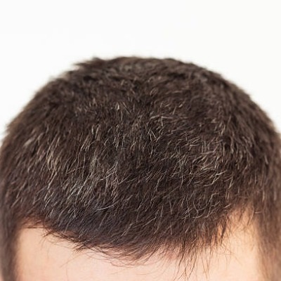 Long-Lasting Results with Hair Transplant Surgery