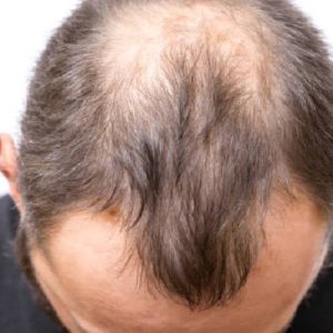 The Complete Guide to Hair Restoration Surgery