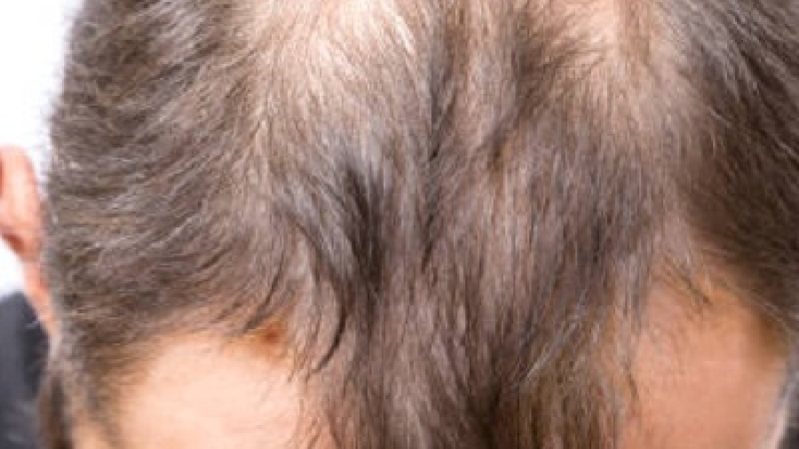 The Complete Guide to Hair Restoration Surgery