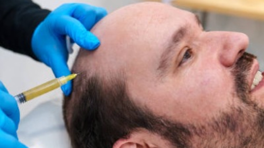When Is the Best Age for a Hair Transplant