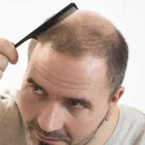Best Hair Transplant Clinic in Islamabad