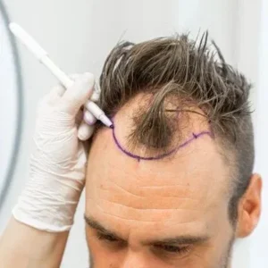 Best PRP Hair Treatment Surgeon in Islamabad