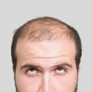Can Hair Transplant Restore Hair Where Nothing Else Works