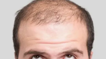 Can Hair Transplant Restore Hair Where Nothing Else Works