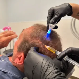 Exosomes Hair Therapy Cost in Islamabad