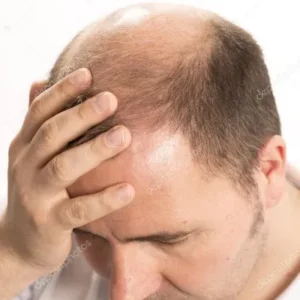 Hair Transplant in Islamabad Benefits and Realistic Results