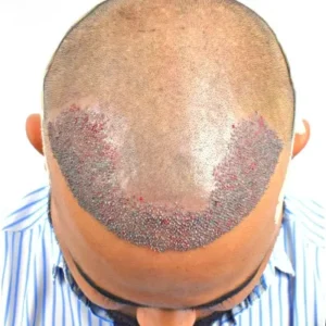 Why Hair Transplant Success Depends on Technique