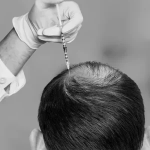 Affordable PRP Hair Treatment Price in Islamabad