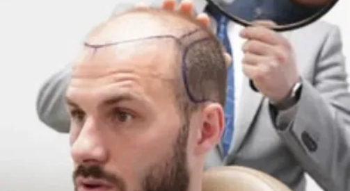 Best Doctor for Exosomes Hair Treatment in Islamabad