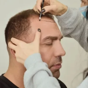 Exosome Hair Therapy Clinics Islamabad