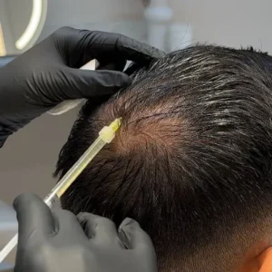 Exosomes hair therapy in Islamabad benefits