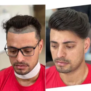 Hair Transplant Secrets How Experts Create Natural Results