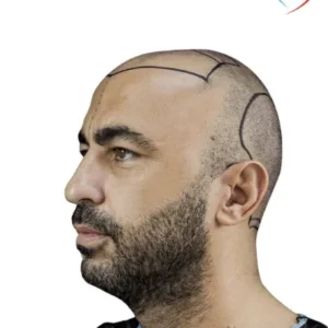 How Hair Transplant Achieves Realistic Results