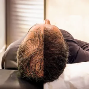 How Much Hair Growth After 3 PRP Sessions