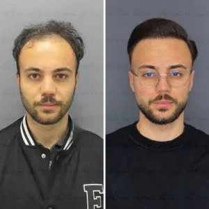 How should a hair transplant look at 5months