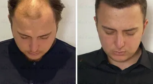 Latest Hair Transplant Technology in Islamabad