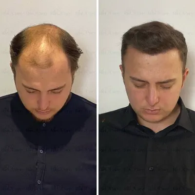 Latest Hair Transplant Technology in Islamabad