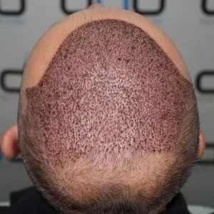 PRP Vs Hair Transplant in Islamabad