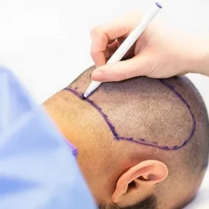 Permanent Hair Restoration Explained