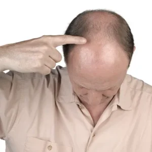 The Ultimate Solution to Permanent Hair Loss