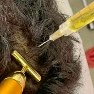 Top 5 benefits of PRP Hair loss