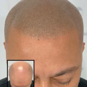 Turn Hair Loss Into Hair Growth