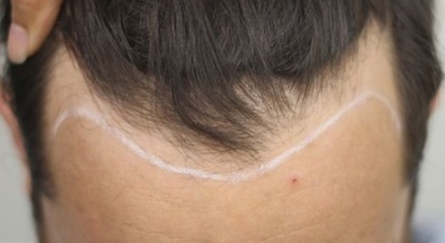 When Does Transplanted Hair Start Growing