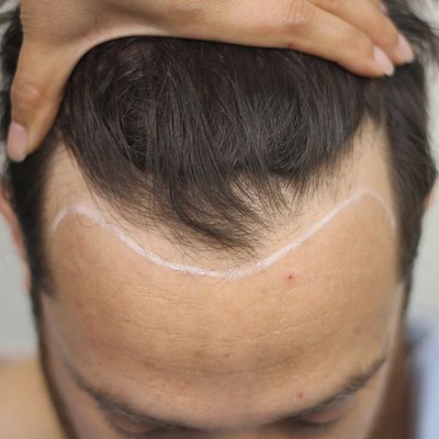 When Does Transplanted Hair Start Growing