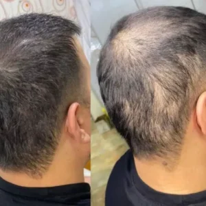 Why Is Hair Transplant a Proven Hair Restoration Method