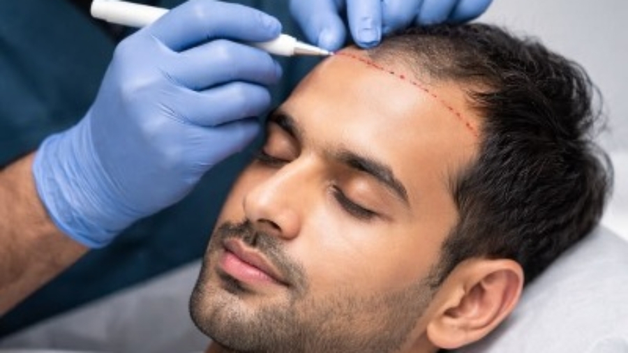Are Hair Transplants Only for Men
