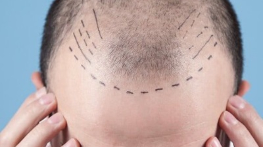 Does the Clinic Provide Patch Tests for Sensitive Scalps