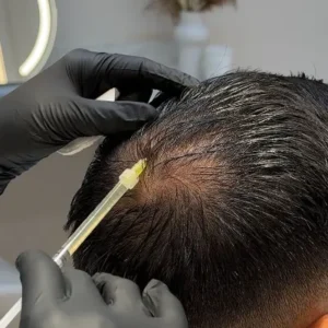 Hair Fall PRP in Islamabad Rawalpindi & Pakistan