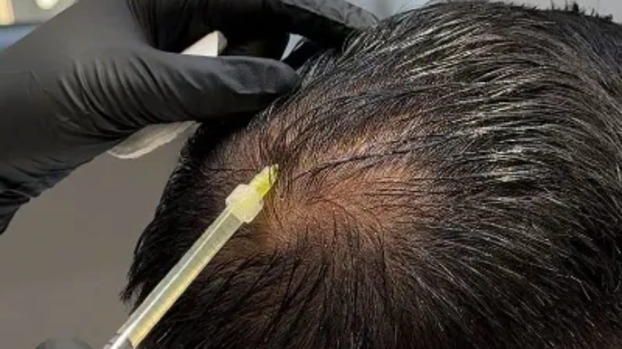 Hair Fall PRP in Islamabad Rawalpindi & Pakistan