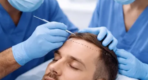 Is Hair Transplant Safe in Pakistan