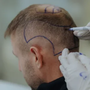 Is Hair Transplant in Islamabad Risk-Free