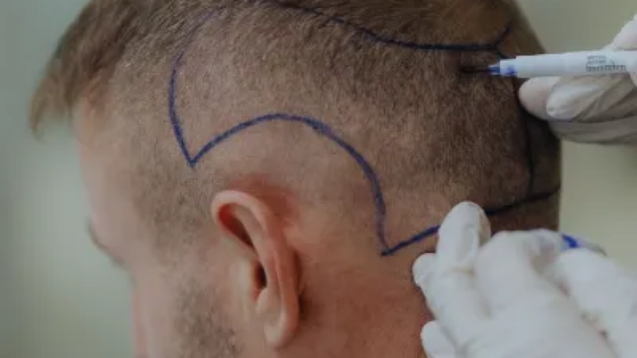 Is Hair Transplant in Islamabad Risk-Free