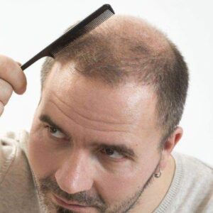 Why Are Specialists Using Exosomes for Hair Loss