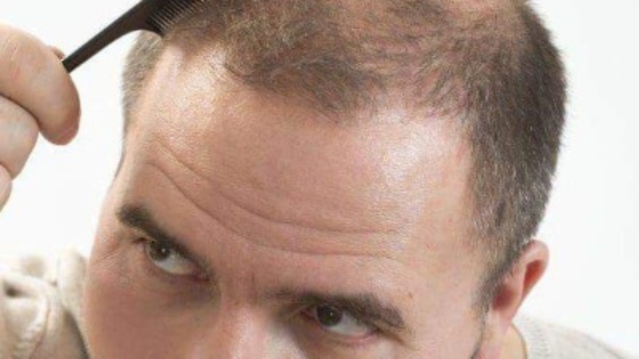 Why Are Specialists Using Exosomes for Hair Loss