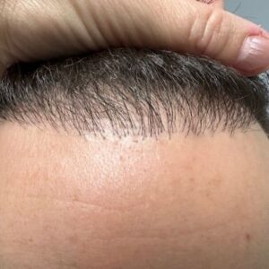 hair transplant in islamabad