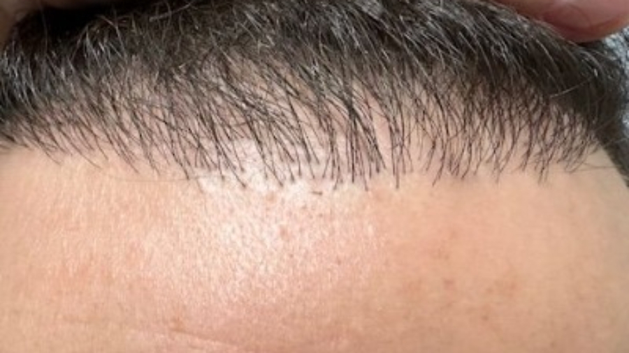 hair transplant in islamabad