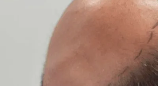 How to stop hair loss with best hair treatment in Islamabad