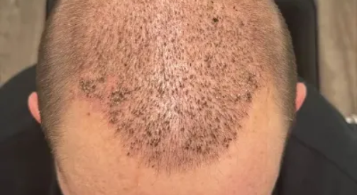 What Is the Best Treatment for Severe Hair Loss FUE, FUT, PRP