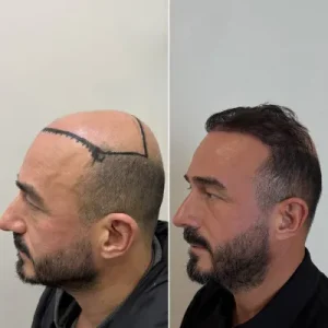 Can Clinic Technology Improve Crown Hair Outcomes